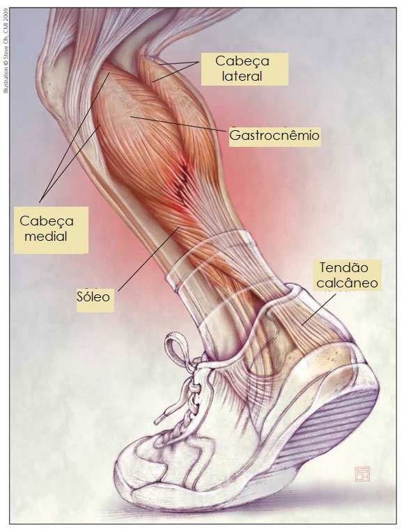 Músculos da Panturrilha: Cabeça lateral, medial, sóleo, tendão, gastrocnêmio